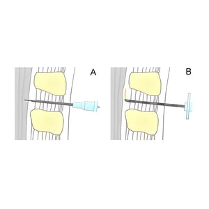 BD Yale Spinal-und Lumbalpunktionskanüle – Becton Dickinson