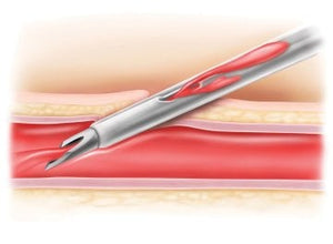 Becton Dickinson Insyte™ Autoguard™ Sicherheitsvenenverweilkatheter mit Flügeln – Becton Dickinson