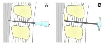 BD Yale Spinal-und Lumbalpunktionskanüle – Becton Dickinson